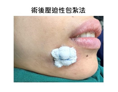術後壓迫性包紮法